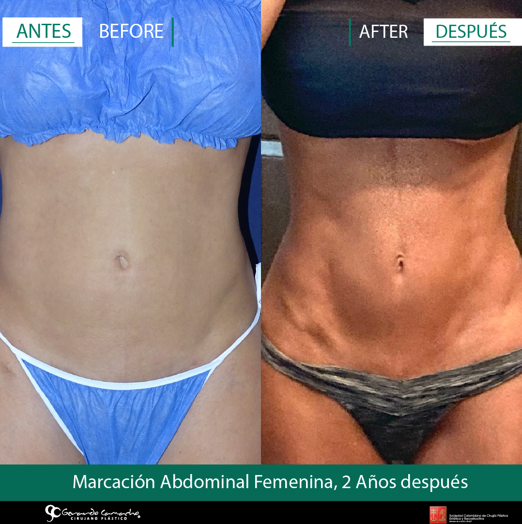 Transformación estética con marcación abdominal en Bogotá